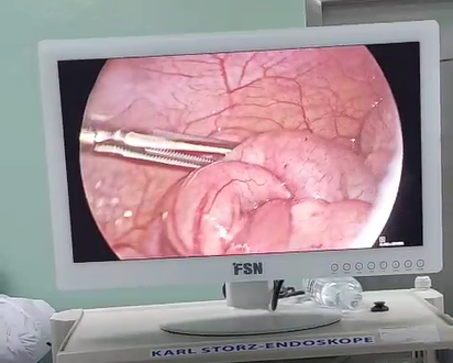 PHẪU THUẬT NỘI SOI CHO BÉ GÁI 51 THÁNG BỊ LỒNG RUỘT